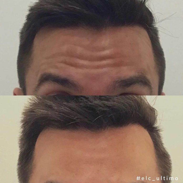 PicoWay Laser Sydney | Acne Scar, Wrinkle & Tattoo Removal by ELC