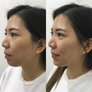 Cosmetic Filler Treatments | Best Cheek Filler Treatment | ELC