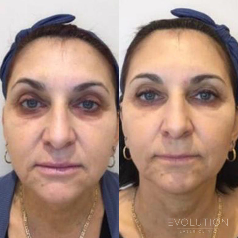 Under-Eye Circles Treatment Sydney | Evolution Laser