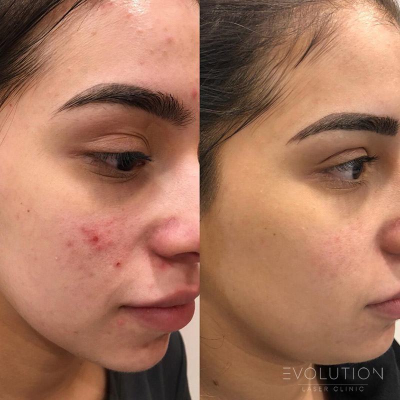 Acne Reduction