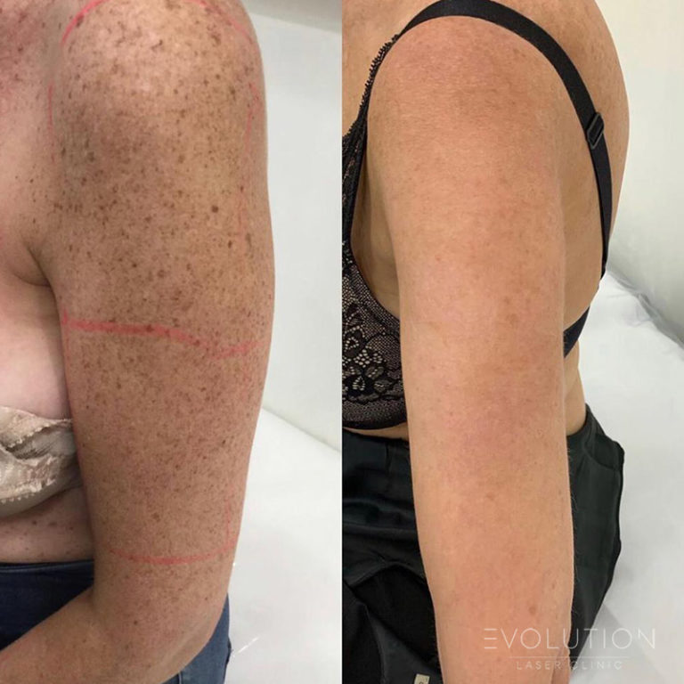 Pigmentation Reduction & Removal Sydney | Laser Pigmentation Removal | ELC