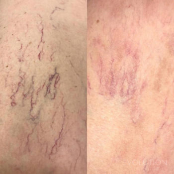 Laser Vein & Capillary Treatment & Removal | Evolution Laser Clinic