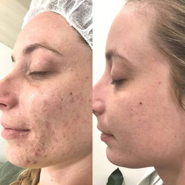 Enlarged Pores Treatment Laser Treatment For Pores Elc