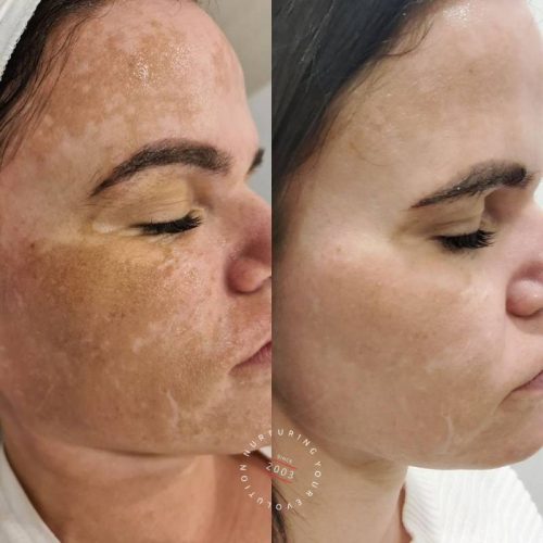 Melasma Treatment Sydney Laser Treatment For Melasma Elc