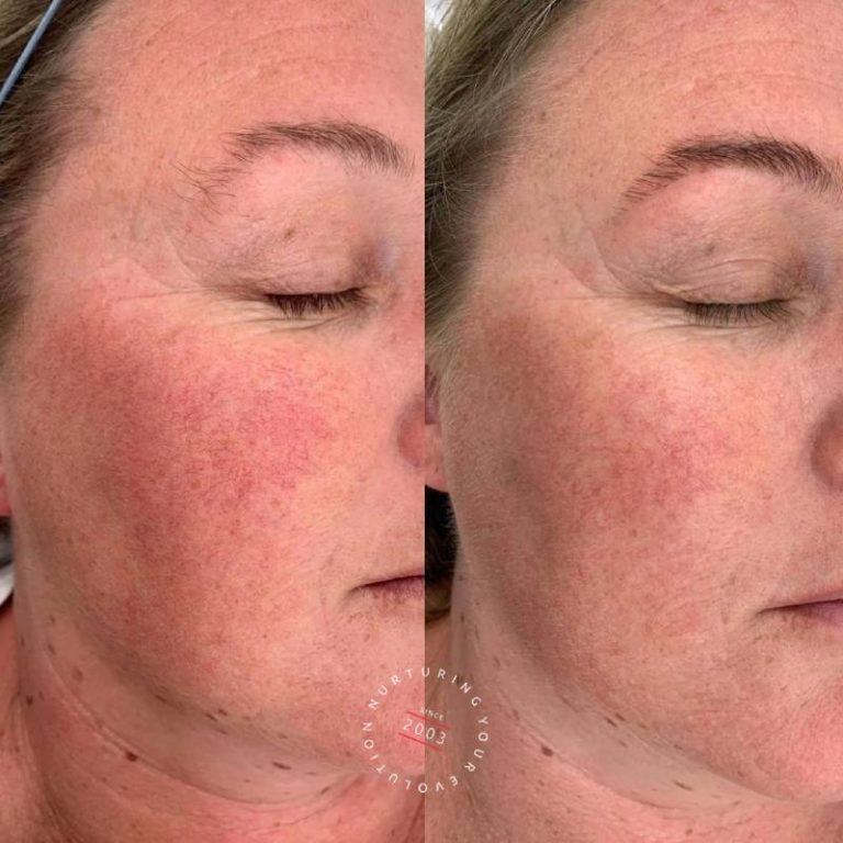 Treating Rosacea Laser Treatment For Rosacea Elc 