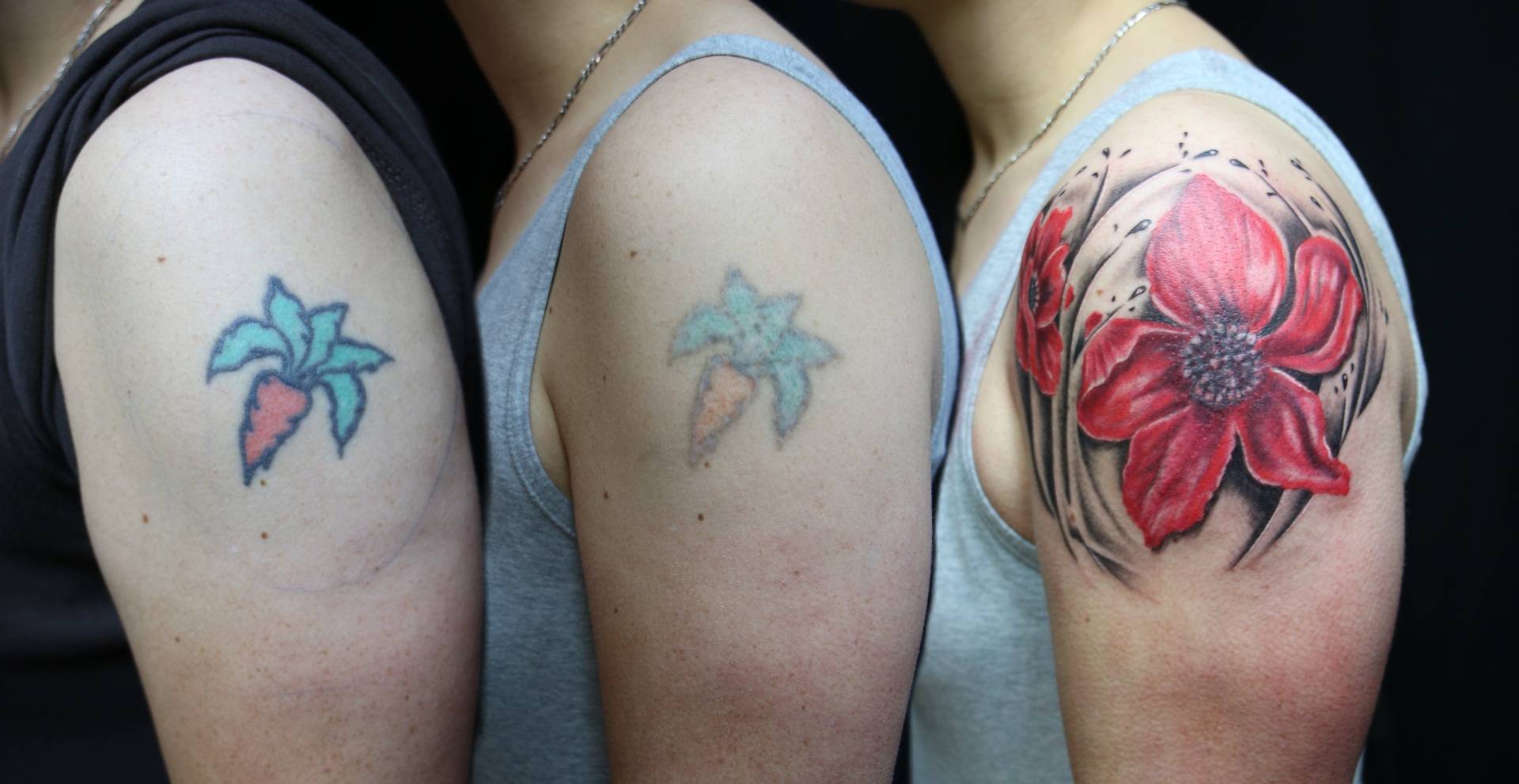 Laser Tattoo Removal Liverpool - Skin Survival Laser Clinic Liverpool