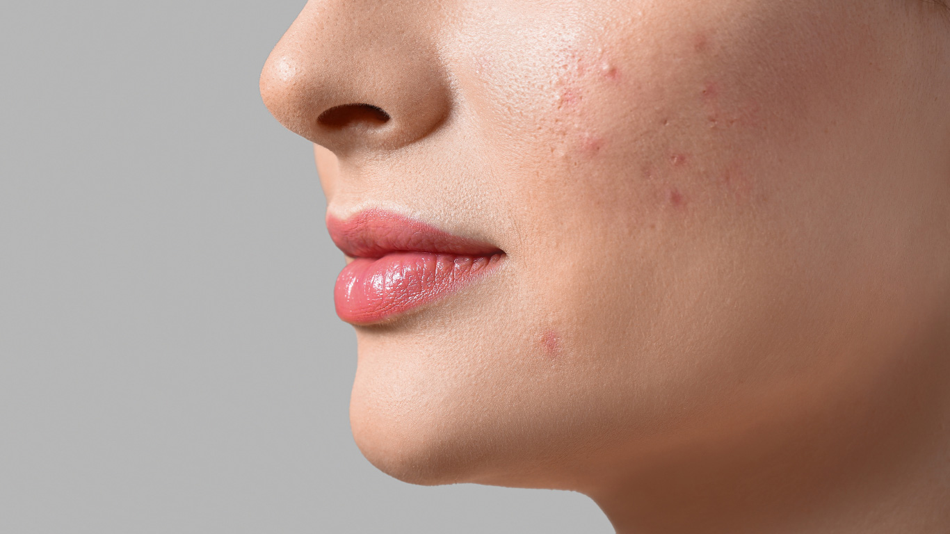 Effective Acne & Bacne Solutions: Clear Skin Tips & Treatments