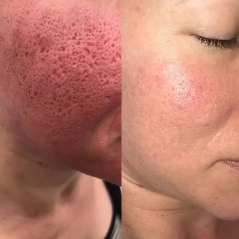 Enlarged Pores