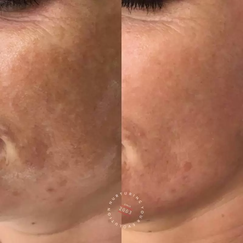 Melasma Treatment