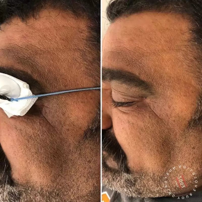 Melasma Treatment