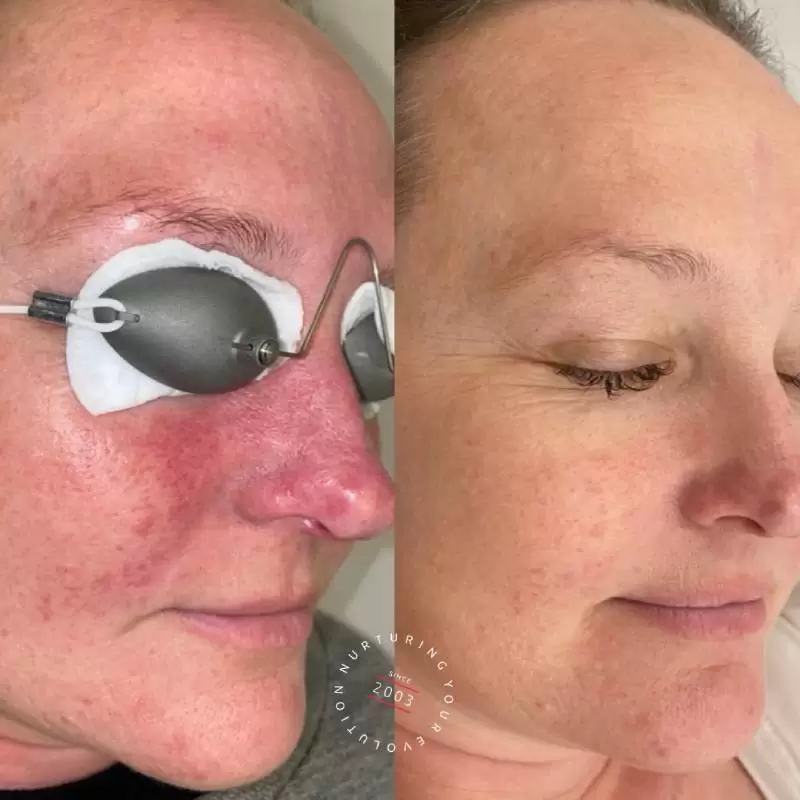 Rosacea Treatment