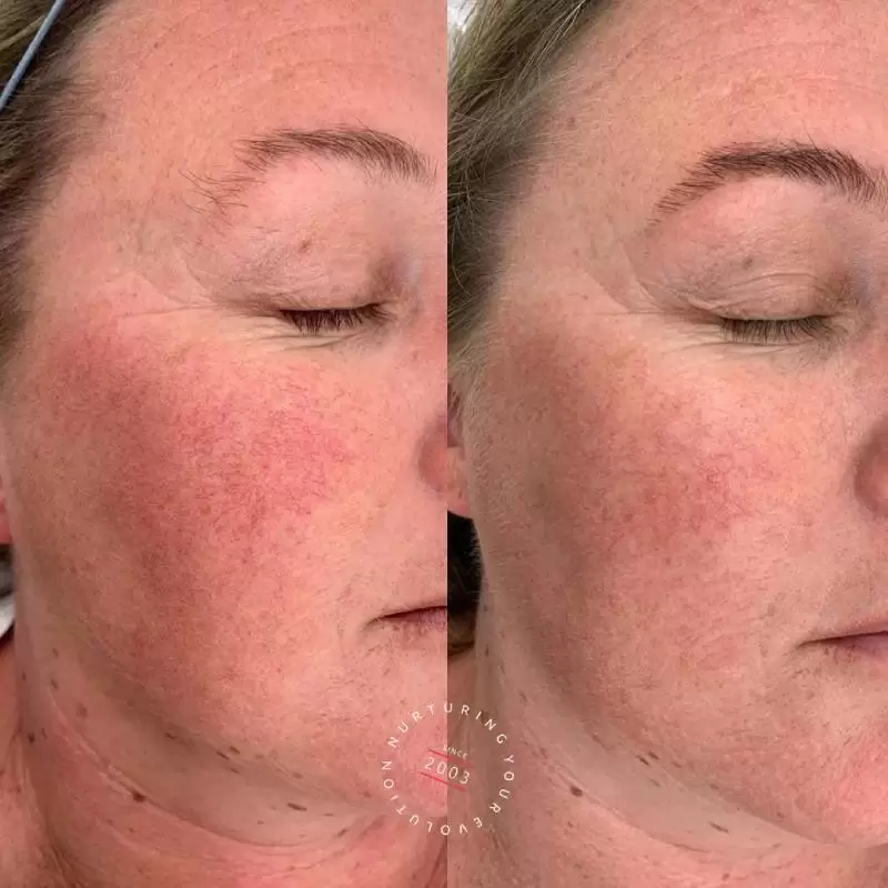 Rosacea Treatment