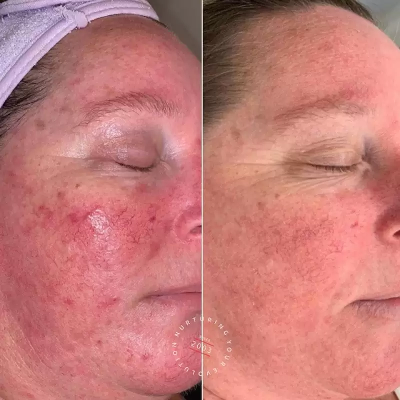 Rosacea Treatment