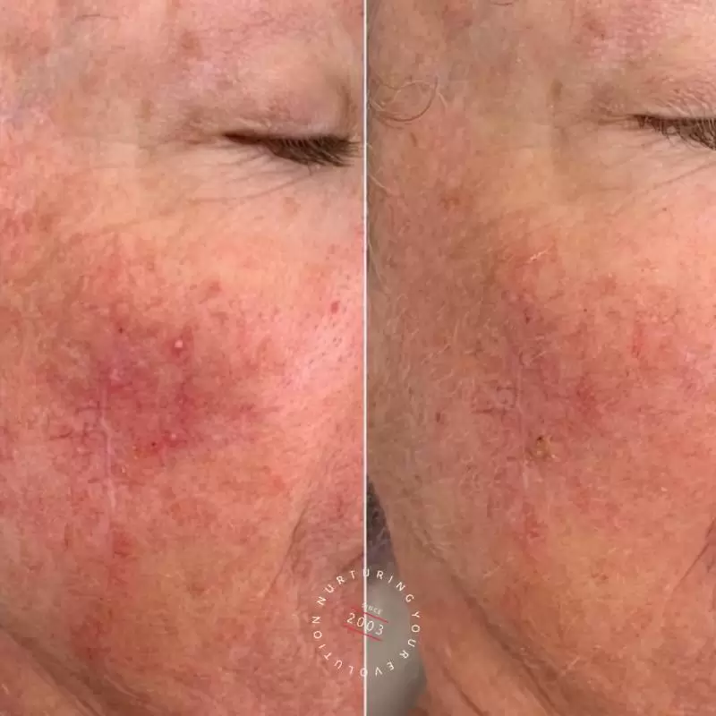 Rosacea Treatment