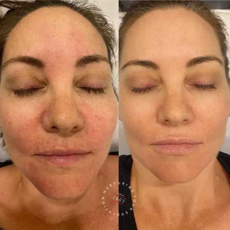 Rosacea Treatment