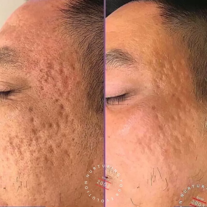 Acne Reduction