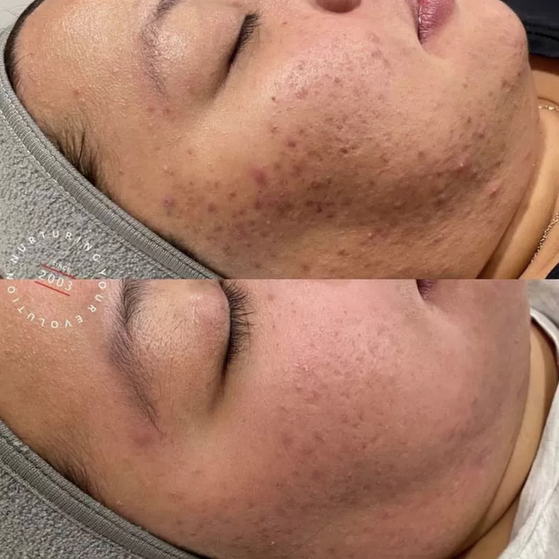 Acne Reduction