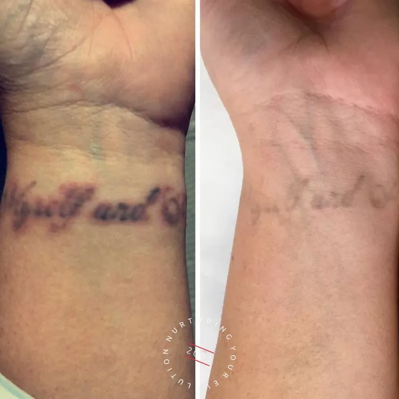 Tattoo Removal