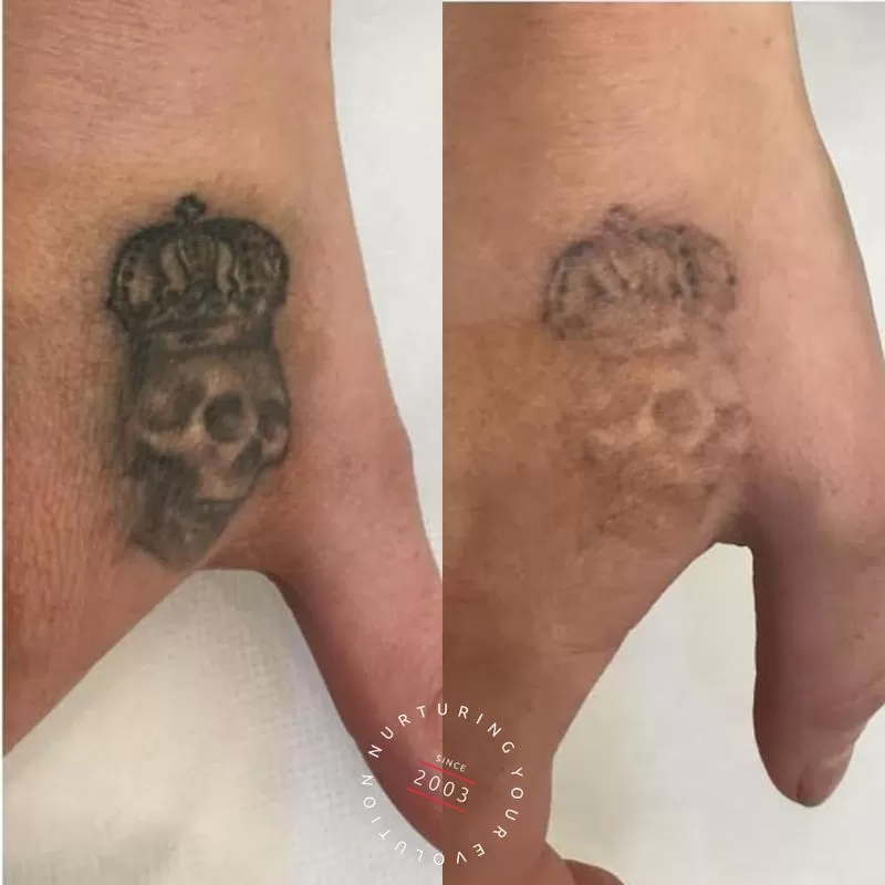 Tattoo Removal