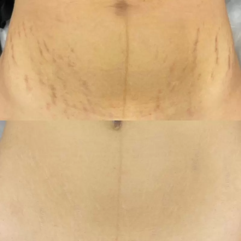 Scar Reduction